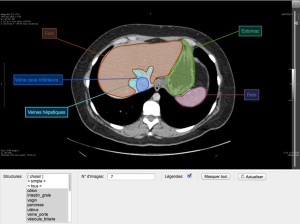 Un outil d’annotation de vidéos pour enseigner la radiologie